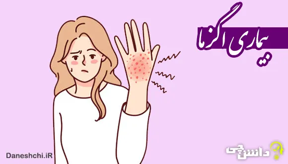 تحقیق در مورد بیماری اگزما و دلایل آن