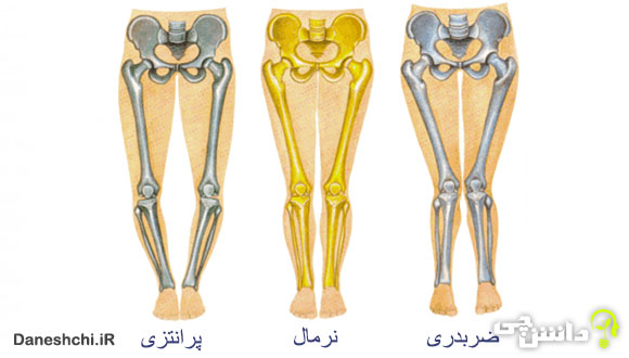 تحقیق در مورد زانوی ضربدری و علل ایجاد آن