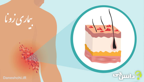 تحقیق در مورد بیماری زونا ، علائم و درمان آن