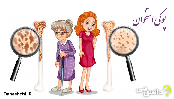 تحقیق درباره عوامل موثر بر پوکی استخوان و منابع غذایی دارای کلسیم و فسفر