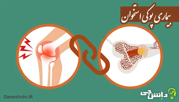 تحقیق در مورد پوکی استخوان، علائم و درمان آن