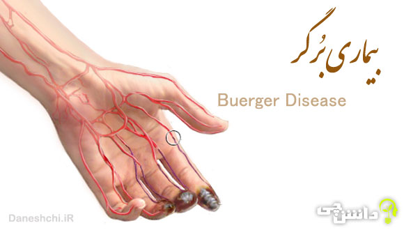 تحقیق در مورد بیماری برگر یا ترومبوآنژئیت انسدادی